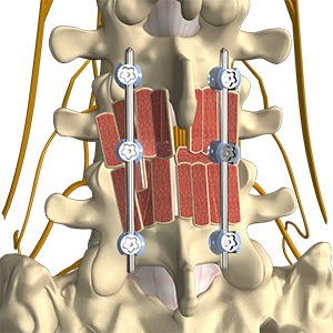 Posterolateral Lumbar Fusion Picture