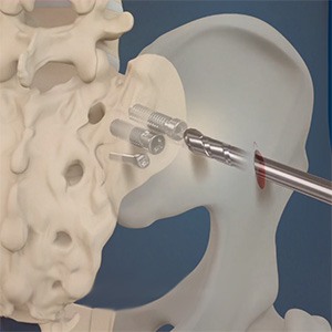 Sacroiliac Joint Fusion Picture