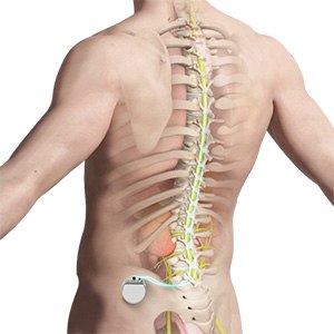 Spinal Cord Stimulator Picture