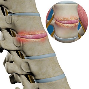 Spinal Infection Picture