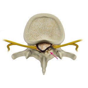 Spinal Stenosis Picture