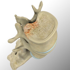 Spinal Tumor Picture