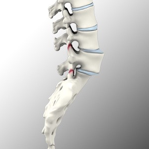 Spondylolisthesis Picture