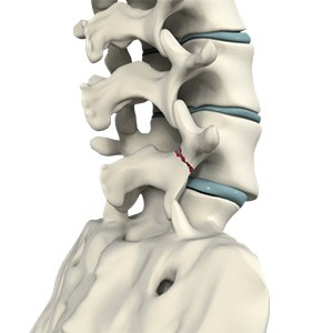Spondylolysis Picture