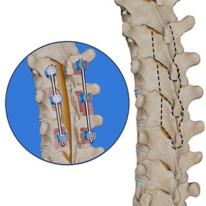 Thoracic Laminectomy / Discectomy Picture