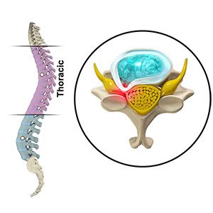 Thoracic Myelopathy Picture