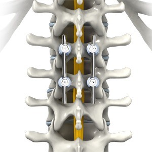 Thoracic Spine Fusion Picture