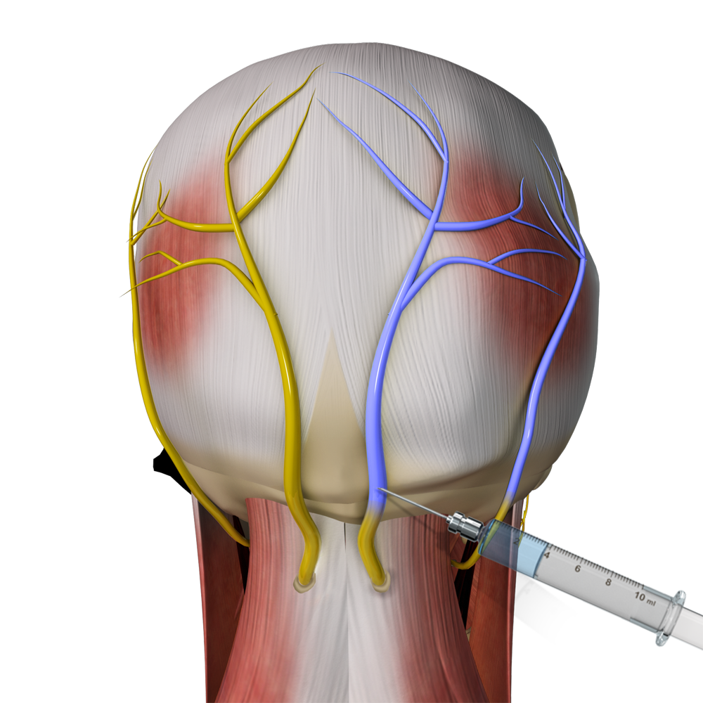 Occipital Nerve Blocks Picture
