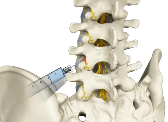 Spinal Injections Picture