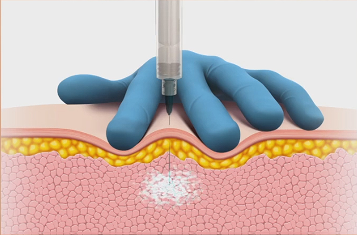 Trigger Injections Picture
