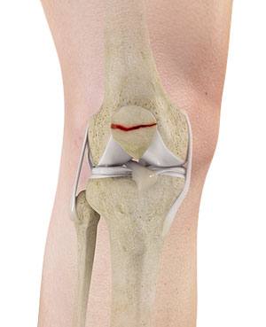 Patella Fracture