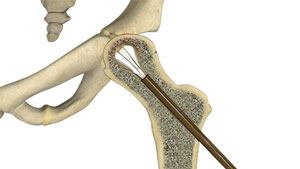 Hip Reconstruction