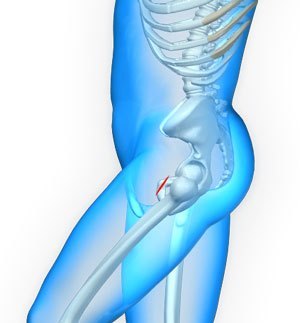 Hip Surgery