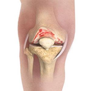 Knee Osteoarthritis