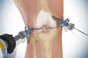Knee Surgery