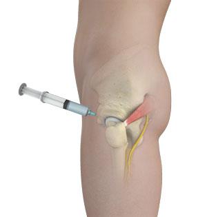 Nonsurgical Hip Treatments