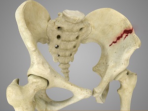 Pelvic Fracture