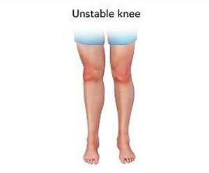 Unstable Knee