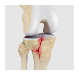 Management of Simple & Complex Fractures image
