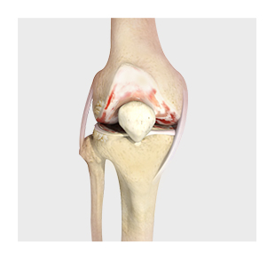 Nonoperative Management of Osteoarthritis image