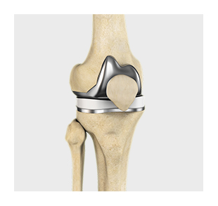 Revision Joint Replacement image