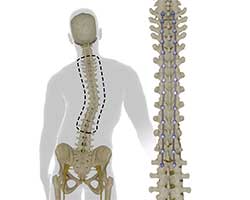 adult scoliosis correction