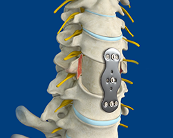 anterior cervical corpectomy and Fusion