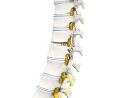 anterior cervical discectomy with fusion