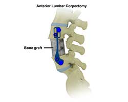anterior lumbar corpectomy and fusion