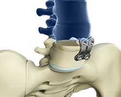 anterior lumbar interbody fusion