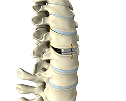 cervical arthroplasty