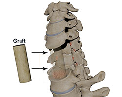 cervical corpectomy and strut graft