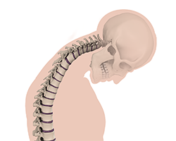 cervical deformities