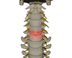 cervical degenerative disc disease