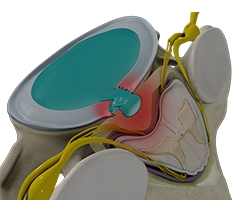 cervical disc herniation