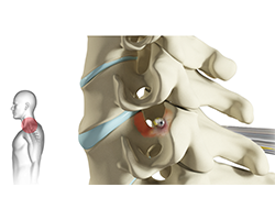 cervical foraminotomy