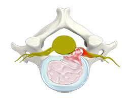 cervical herniated disc