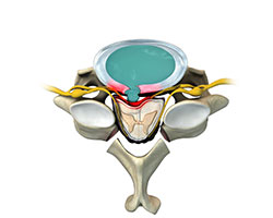 cervical laminectomy