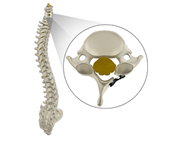 Cervical laminoplasty