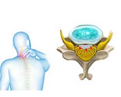 cervical  myelopathy