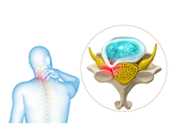 cervical radiculopathy myelopathy