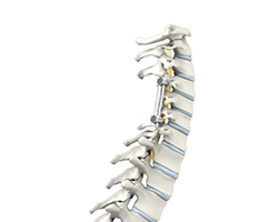 cCervical spine fusion