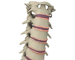 cervical spondylolysis