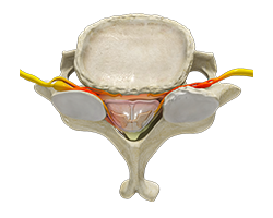 cervical stenosis