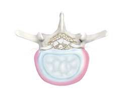 degenerative disc disease