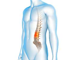 degenerative spinal conditions