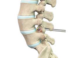 degenerative spine surgery