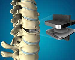 disc arthroplasty