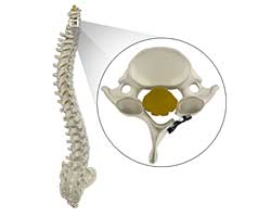 disc decompression