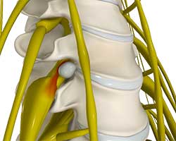 disc herniation